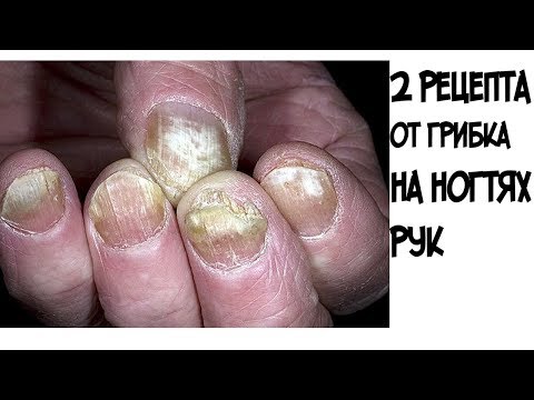 Das Wasser für die Behandlung der Nägel Pimafuzin von gribka der Nägel bei der Schwangerschaft