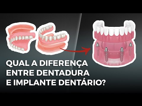 Qual a diferença entre dentadura e implante dentário?