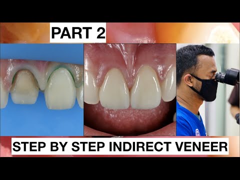 Step by Step 2 Indirect Veneer with Discoloration Tooth. Part 2