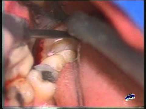 comment soulager extraction dent sagesse
