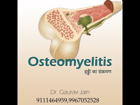 Osteomyelitis bone infection explained by Dr Gaurav Jain – YouTube video thumbnail