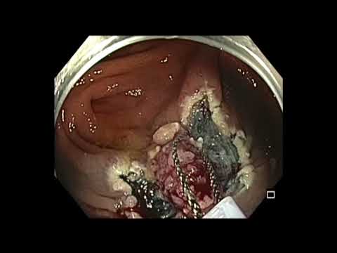 Colonoscopy: Cecal Polyp with a tattoo - Piecemeal EMR