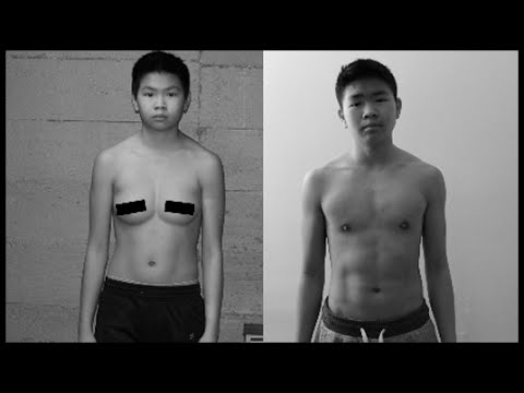 ซึ่งในสค์ขยายขนาดหน้าอก หน้าอกเดือนของแข็งหลังจาก mammoplasty