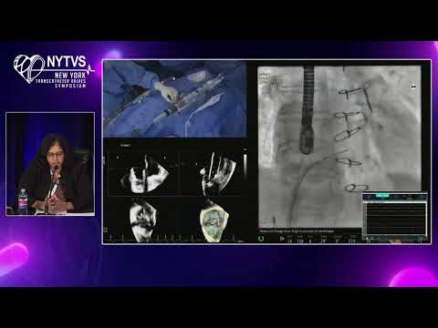 LIVE CASE 5 - Transcatheter Tricuspid Valve Replacement using Evoque