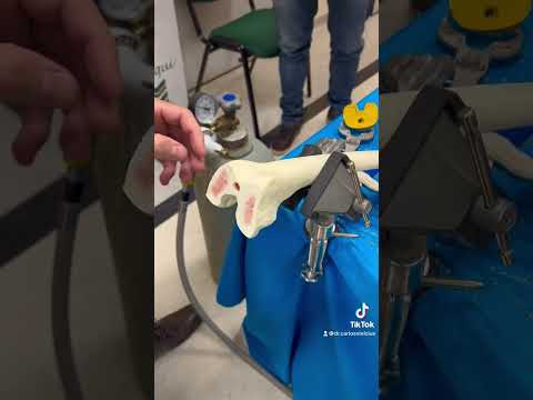 Como é feita a cirurgia pra colocar a prótese de joelho.