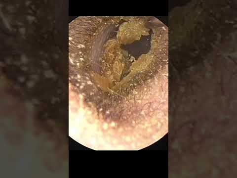 EAR WAX REMOVAL #Shorts #096