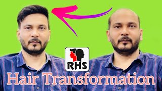Hair Transformation Hyderabad | Rizy Hair | Hair Fixing Hyderabad | Hair Patches  in Hyderabad