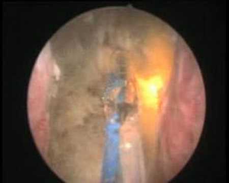 Vaporisation photosélective de la prostate au laser Greenlight HPS