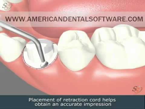 Video showing the installation of a dental crown