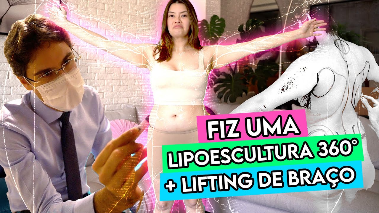 DIÁRIO DA MINHA LIPOESCULTURA 360° + LIFTING DE BRAÇO 💪🏼COM RENUVION 🎉 - VLOG 1