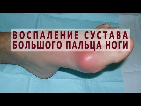 Из за чего бывает воспаление сустава большого пальца ноги?