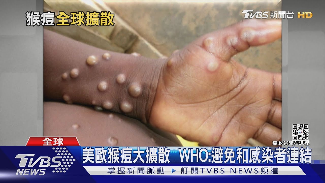 紐約、以色列爆猴痘疫情 全球逾14國破百例