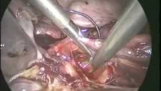 preview picture of video 'Total Laparoscopic Hysterectomy'