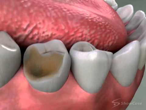 Crowns Core Build Up Procedure