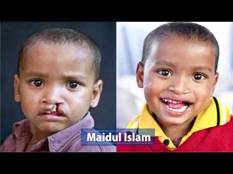 Mission Smile Fundraiser for 75 Children - India