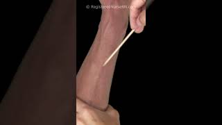 Download lagu Vein Bifurcation When Starting an IV Forearm | Intravenous IV Cannulation #shorts #IV #nurse mp3 Download lagu Vein Bifurcation When Starting an IV Forearm | Intravenous IV Cannulation #shorts #IV #nurse mp3