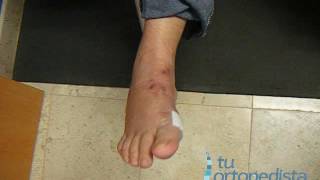 PIE LISFRANC 3 MESES DE RECUPERACION - tuortopedista.com
