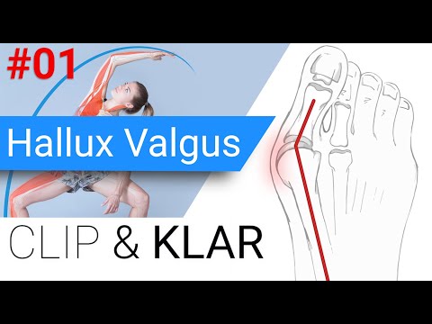 Hallux Valgus erklärt - Schiefstand der Grosszehe