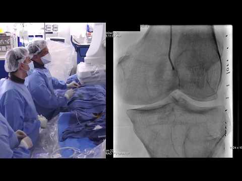 Chronic total occlusion (CTO) of left popliteal artery
