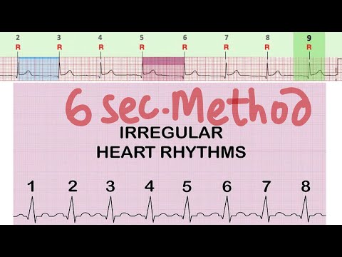 ECG-Heart Rate Calculation in Irregular Rhythm , 6 second Method