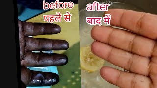 How to Remove Hair Dye from skin | घंटो का काम मिंटो में | Dye hatho se nikale chutkiyo main..