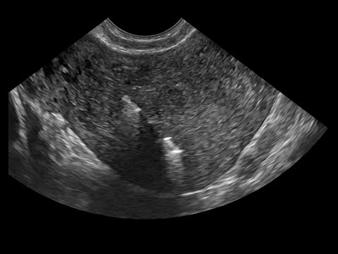 Complicação do DIU: deslocamento por rotação diagnosticado pela ultrassonografia transvaginal