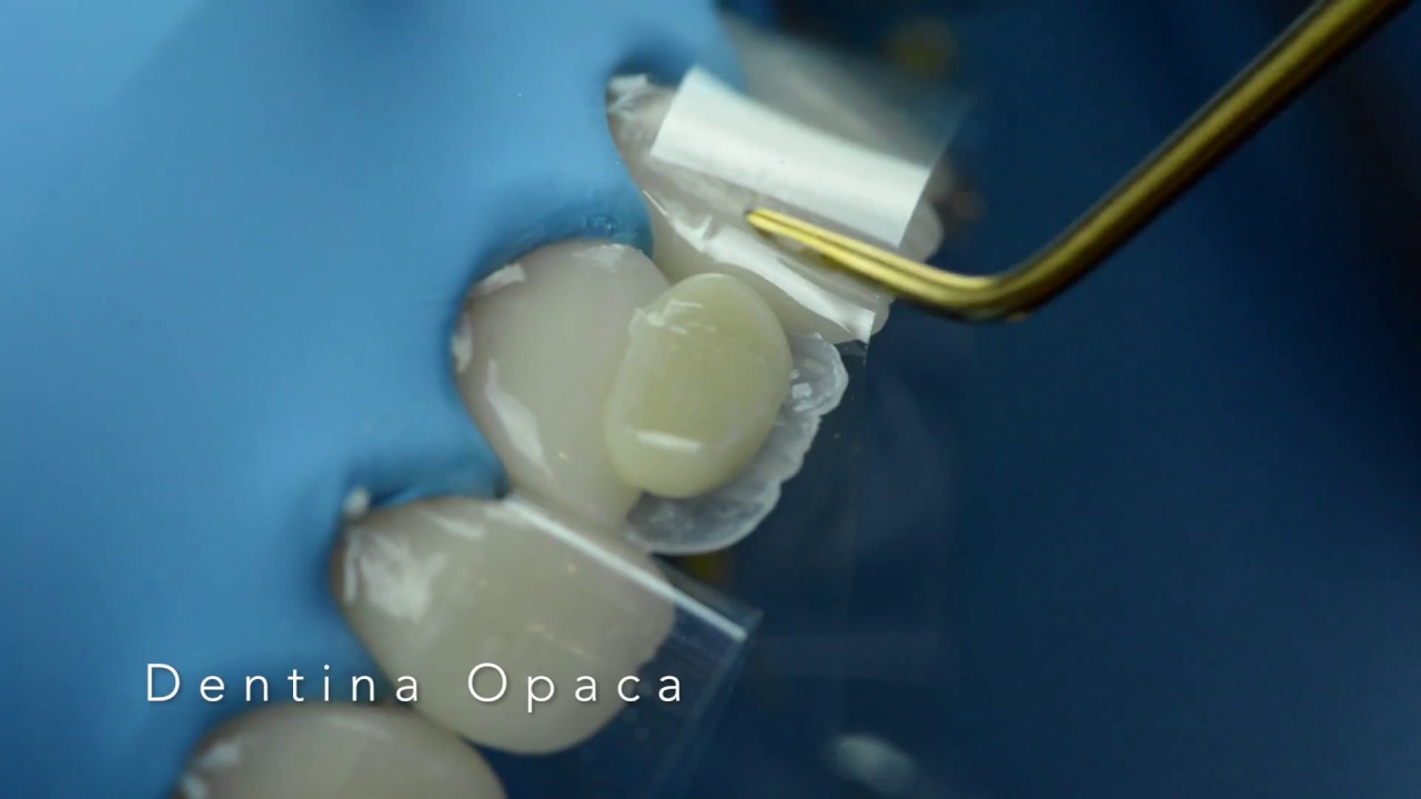 3 Dentina de cuerpo y diseño de mamelones