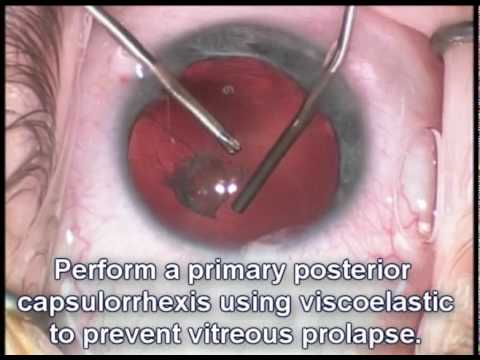 Cataract Surgery - Pediatric Patient