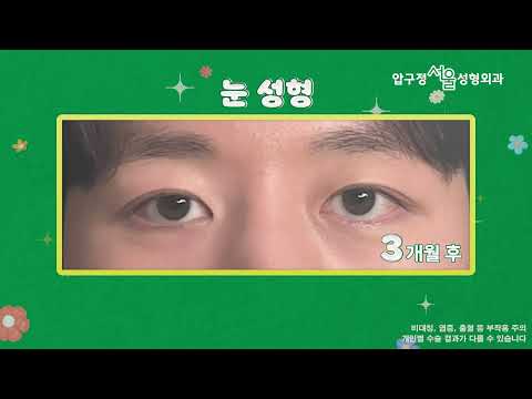 자연스러운 남자 비절개 눈매교정 전후