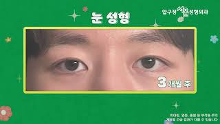 남자 비절개 눈매교정 전후