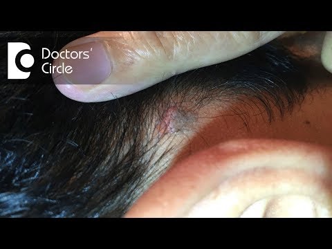 Is it normal to have painful lump behind the ear? - Dr. Sreenivasa Murthy T M