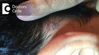 Is it normal to have painful lump behind the ear? - Dr. Sreenivasa Murthy T M