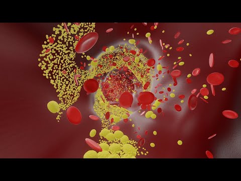 Mayo Clinic Minute - Strategies to reduce diabetes and heart disease