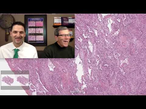 Pattern 1 – Acute Lung Injury, Amiodarone Induced DAD (Top 25 Pearls Series, Topic 6, Pearl 4)