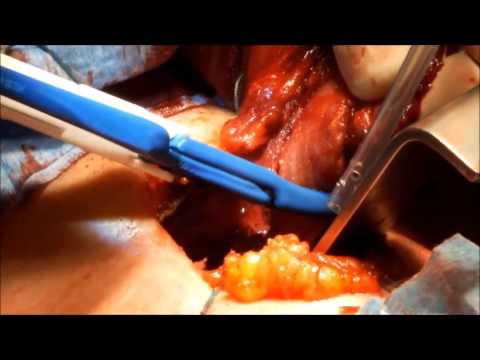 marClamp® Cut IQ and maxium® - Thyroidectomy