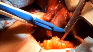 marClamp® Cut IQ and maXium® | Thyroidectomy