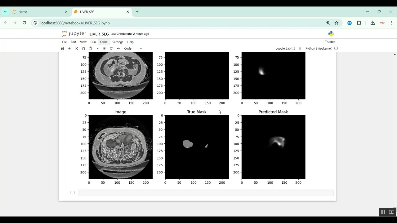 Liver Tumor Segmentation in Python Projects