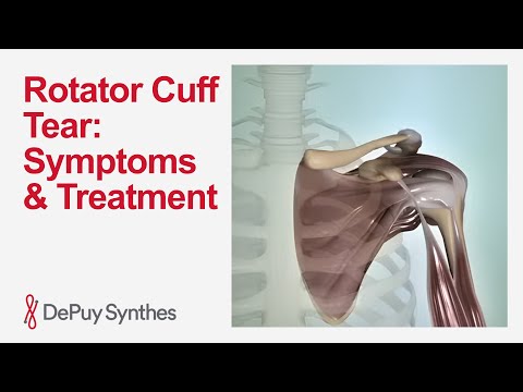 Torn Rotator Cuff: What You Need to Know About Causes, Symptoms and Treatment | DePuy Synthes