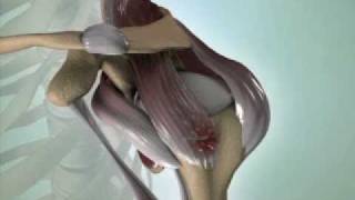 Torn Rotator Cuff Causes, Symptoms & Treatment - DePuy Videos