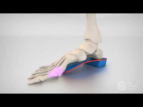 Treating Hallux Rigidus | Vancouver Orthotics | Dr  Michael Horowitz | 604 737 3668