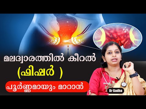 ഫിഷർ  പൂർണ്ണമായും മാറാൻ /Dr Gadha