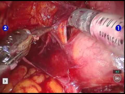 Retrograde Versus Antegrade Nerve Sparing During Robot-assisted Radical Prostatectomy