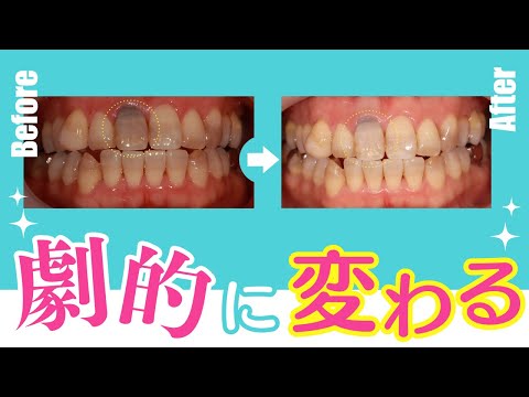 神経のない歯をホワイトニング！？