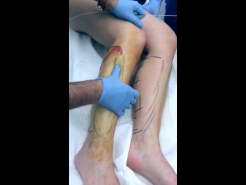 Infiammazione dellarticolazione del ginocchio che medico cura Metodi di dolore e di trattamento congiunto