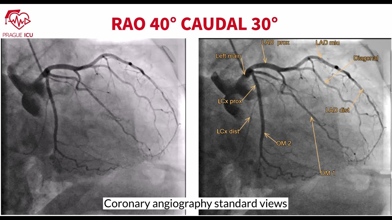 Coronary angiography standard views
