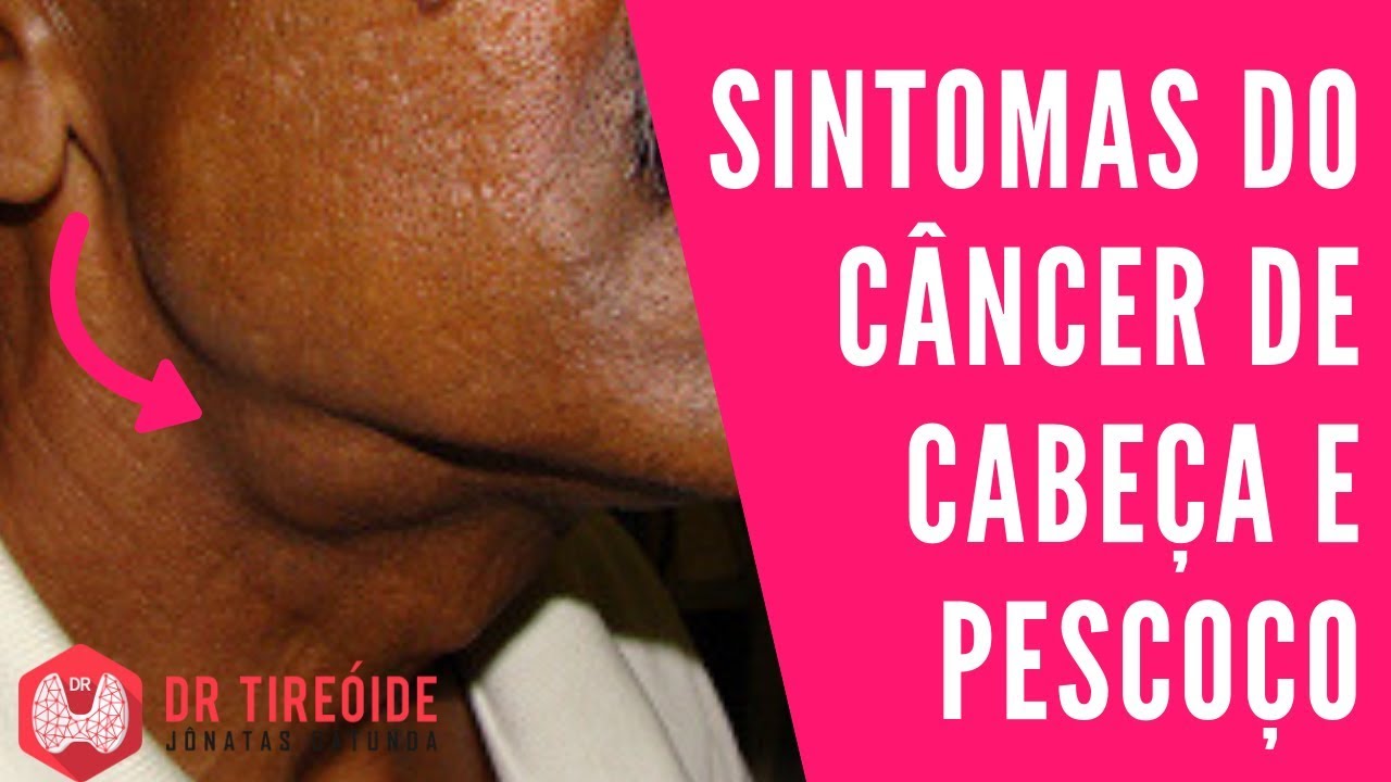 Sintomas do Câncer de Cabeça e Pescoço | Dr Jônatas Catunda