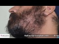 Get the Best Beard Hair Transplant by Dr. Suneet Soni at Medispa