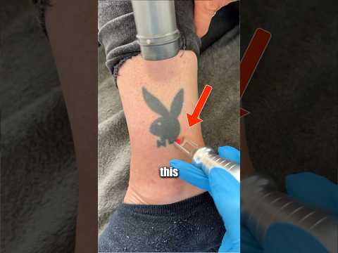 How Laser Tattoo Removal Is Done (@hwclinicbrugge)
