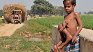 The Boy with 8 Limbs in India