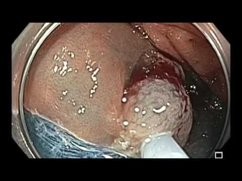 Colonoscopy: Ascending Colon EMR - Large Flat Lesion